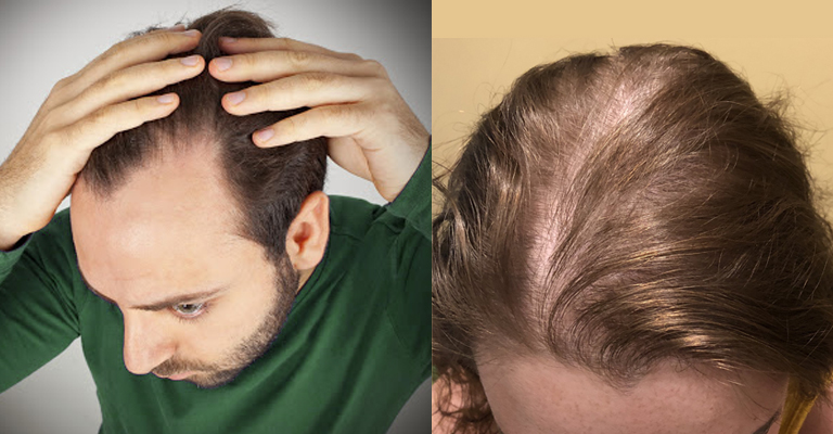 Early Age Balding Heres What To Know Hair Transplant And Restoration